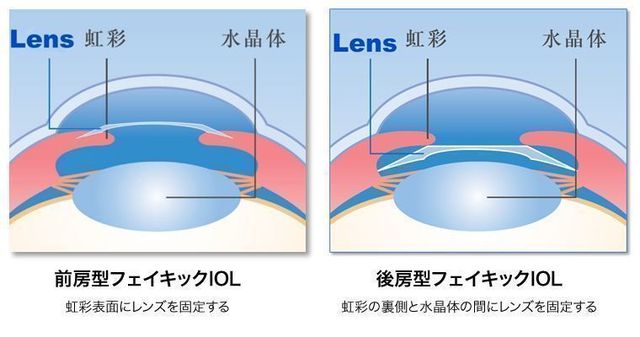 フェイキック