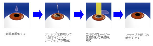 レ―シック