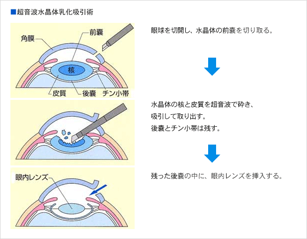 白内障の手術
