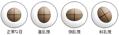 乱視の種類