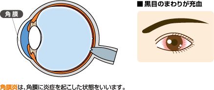 角膜炎
