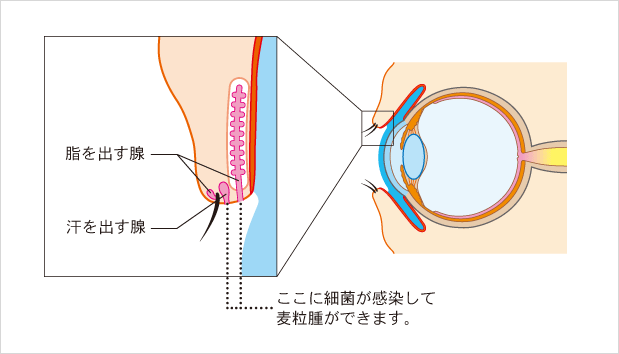 麦粒種になる仕組み