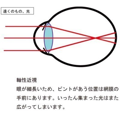 軸性近視