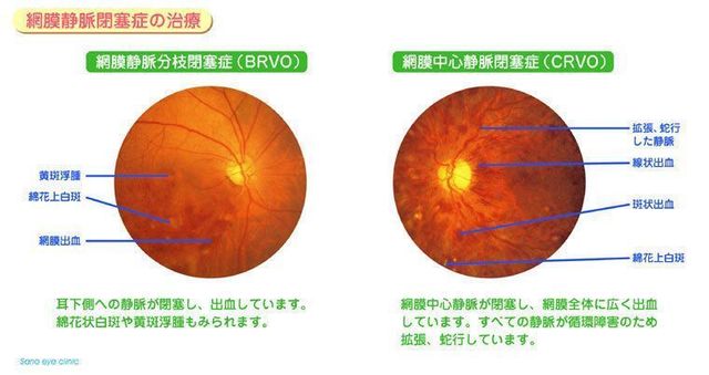 網膜静脈閉塞症