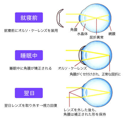 オルソケラトラジーによる矯正