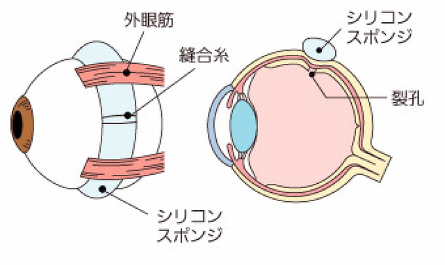 網膜剥離の手術方法