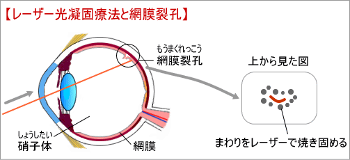 網膜裂孔
