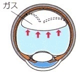 硝子体手術・ガス