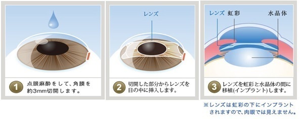 エキシマレーザーを用いた手術方式で、手術をする方の眼の乱視状況をコンピュータで計測します。 そして、角膜を切開した後で、レーザーの照射で矯正していきます。 手術の前にインプットされた情報を元に計算した照射量をあてることから、困難とされている乱視の矯正も可能になります。  眼内コンタクトレンズ挿入術