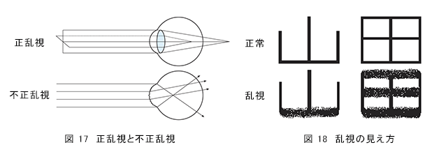 正乱視
