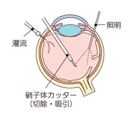 硝子体手術