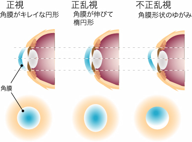 角膜の歪み