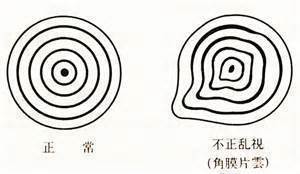 不正乱視