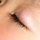 プールは禁止？子供の霰粒腫（ものもらい）、目薬から手術まで治療法を紹介！